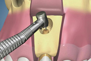 Apical Surgery-Anterior-No Sinus Tract